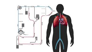 Modified Thermodilution in Extracorporeal Therapy [upl. by Acilegna]