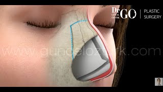 Let Down amp Push Down Preservation Rhinoplasty Nose Job Operation Guncel Ozturk MD DRGO [upl. by Akiv]