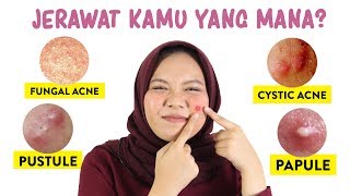 Jenis Jerawat dan Cara Mengatasinya  Skincare101 [upl. by Cristi476]