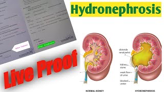 Hydronephrosis Homeopathic Treatment Draravind Homeopathy [upl. by Binah]