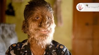 Werewolf Syndrome Teenager Shares Human and Animal Traits  Body Bizarre [upl. by Anirbus]