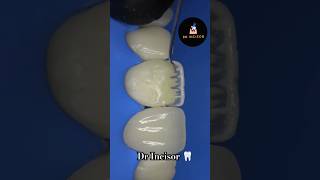 Dr Incisor Dentine layering dental dentist dentistry smile teeth dentalcare dentalclinic [upl. by Esinrahs]