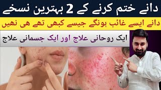 acne control treatment acne pimples remove face wash  dany khatam karne ka best tarika [upl. by Shaeffer]