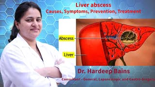 Liver abscess  लिवर एब्सेस रोग क्या है  यकृत फोड़ा  Dr Hardeep Bains [upl. by Ykroc]