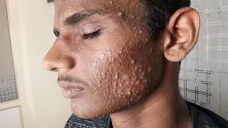 Steroid induced Acne Vulgaris Dr Bhutada Skin India [upl. by Mehalek700]