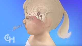 Endoscopic Neurosurgery for Brain Tumors in Children [upl. by Junno]