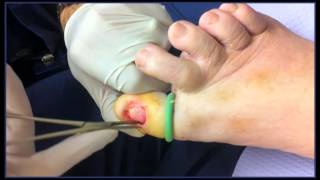 Permanent Removal of a Patients Toenail by Dr Neuhaus [upl. by Ruperta183]