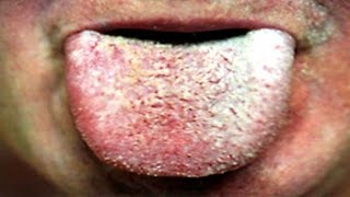 Home remedies for white coated tongue [upl. by Leinad]