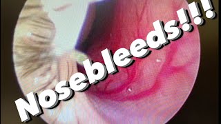 Nosebleeds epistaxis causes prevention treatments and more [upl. by Gerald]