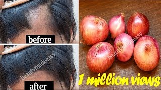 Grow your Hair Faster with Onion Juice  STOP Hair Fall with Home Remedy  100 Working [upl. by Oirasec]