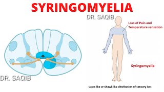 Syringomyelia [upl. by Ordnassela]