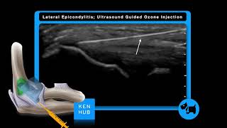 Lateral Epicondylitis Ultrasound Guided Ozone Injection [upl. by Gnah872]