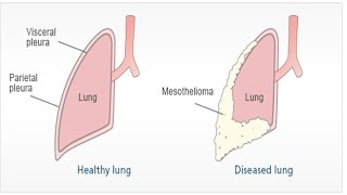 Pleural Mesothelioma  Asbestosis Symptoms and Treatment  Malignant Peritoneal Mesothelioma [upl. by Garth]