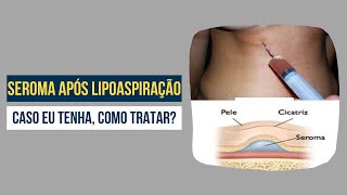 Seroma  Sempre aparece após a lipoaspiração Como tratar  Dr Ricardo Drummond [upl. by Eiramrefinnej]