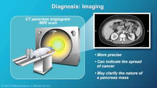 Pancreatic Cancer Pathophysiology Diagnosis and Staging [upl. by Llydnek]