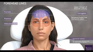 Functional Anatomy of the Upper Face amp Corresponding Injection Sites with BOTOX Cosmetic [upl. by Onimixam590]