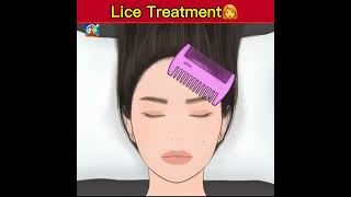 Head Lice Remove Treatment3D Animation shorts youtubeshorts ytshorts animation [upl. by Mohamed]