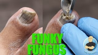 HAVE NAIL FUNGUS YOU NEED TO BE DOING THIS SUPER IMPORTANT TIP [upl. by Marou527]