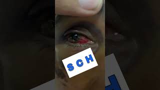 Subconjunctival Hemorrhage Part 4 Shorts SubconjunctivalHemorrhage [upl. by Arayc]