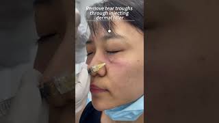 How to do tear trough filler with cannula [upl. by Maurilia733]