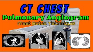 CT Chest Pulmonary Angiogram Test Bolus Technique [upl. by Irrak]