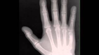 Hyperparathyroidism on Hands on X ray [upl. by Lexie]