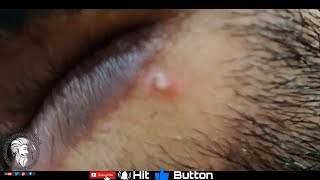 Best Blackheads 2020 waxperloft Acne Healing Time lapse in four days [upl. by Krantz]