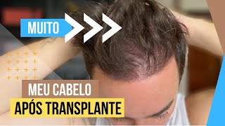 RESULTADO TRANSPLANTE CAPILAR  VITAMINAS QUE EU USO [upl. by Editha]