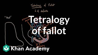 Tetralogy of fallot  Circulatory System and Disease  NCLEXRN  Khan Academy [upl. by Asiram916]