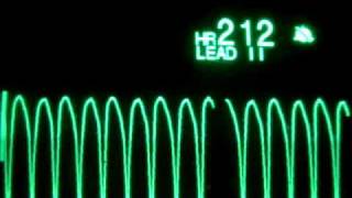 Pulseless Ventricular Tachycardia pVT [upl. by Ahsil]