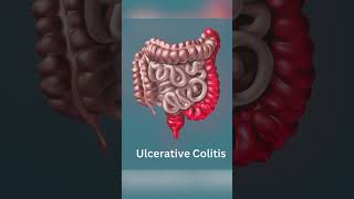 Understanding Crohns Disease vs Ulcerative Colitis [upl. by Epotimet]