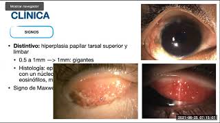 Queratoconjuntivitis Vernal Dr Marcos Restrepo [upl. by Patten298]