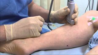 Foam sclerotherapy for varicose veins  Philip Coleridge Smith [upl. by Barthol]