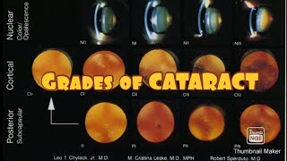 Grades of CATARACT 👀 [upl. by Amsden]