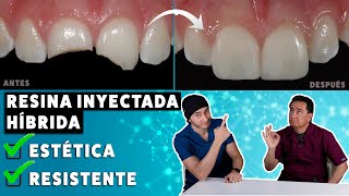 Carillas de Resina Inyectada Híbridas ¡Estéticas pero Resistentes  Una excelente alternativa [upl. by Nicolais]