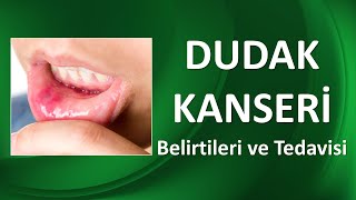 DUDAK KANSERİ NEDİR BELİRTİLERİ NELERDİR [upl. by Gentilis]