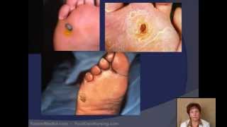 Corn amp Callus Debridement by a Podiatrist [upl. by Selhorst960]