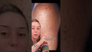 Acne vs Keratosis Pilaris shorts [upl. by Bryce163]