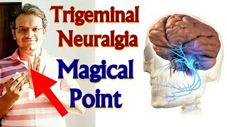 Acupressure Points For TRIGEMINAL NEURALGIA Acupressure For Trigeminal Neuralgia MADE EASY  HINDI [upl. by Guimond]