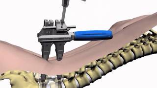 Perkutane minimalinvasive Versteifung der Lendenwirbelsäule [upl. by Roth]