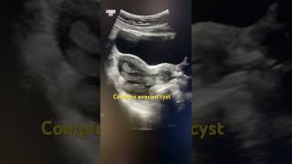 Ovarian cyst ultrasonography [upl. by Enehs]