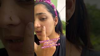 Tretinoin Truth My Skin Before amp After 😲TretinoinJourney SkinTransformation BeforeAndAfter [upl. by Eade]