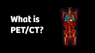 What is PETCT and how does it work [upl. by Marin]