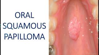 Oral Squamous Papilloma  Benign Tumour of Epithelial Tissue I Dental Guide I Dr Bimal Chand I [upl. by Sair]