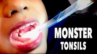 MONSTER TONSILS  Abscess Tonsillitis  Dr Paul [upl. by Cul]