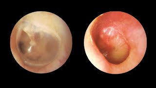 otitis media aguda  ESPANOL [upl. by Chao]