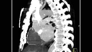 Cardiac Type B Dissection as well as Coronary Artery Disease 2 of 7 [upl. by Anahgem]