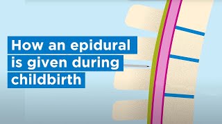 How an epidural is given during childbirth  Bupa Health [upl. by Ertnom]