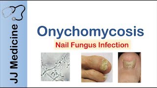 Onychomycosis  Nail Infection  Signs Symptoms Treatment [upl. by Neddra920]