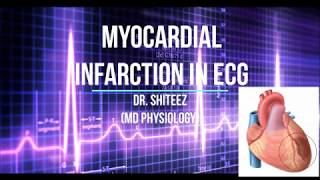 Myocardial Infarction MI ECG in HIndi [upl. by Eirdua]